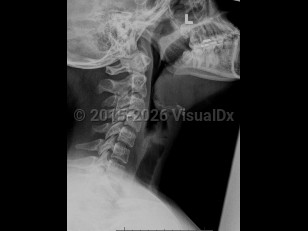 Epiglottitis