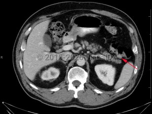 Colonic polyps