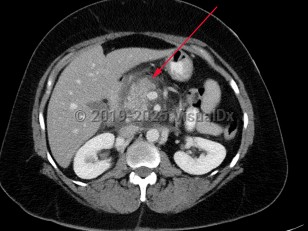 Acute pancreatitis