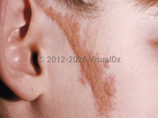 Nevus sebaceus
