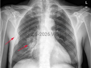 Imaging Studies image of Lung cancer - imageId=7909788. Click to open in gallery.  caption: '<span>There is a large mass within the right lung in a perihilar location compatible with bronchogenic carcinoma. There is metastatic disease involving the right 5th rib with bony destruction, and a large extrapleural mass.</span>'