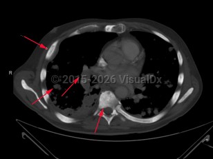 Imaging Studies image of Metastatic prostate carcinoma - imageId=7910099. Click to open in gallery.  caption: '<span>Axial CT scan through the chest  demonstrates widespread metastatic disease from prostate cancer with  innumerable pulmonary nodules, mediastinal adenopathy, and replacement of  all the bones by sclerotic metastases.</span>'
