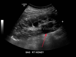Polycystic kidney disease