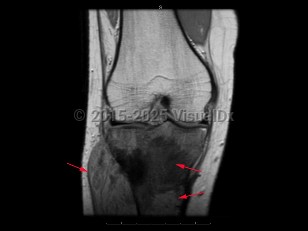 Imaging Studies image of Osteosarcoma - imageId=7912443. Click to open in gallery.  caption: '<span>Coronal T1 MRI sequence  demonstrates an infiltrative mass within the proximal tibial metaphysis  with low T1 signal, periosteal reaction/breakthrough, and an associated  soft tissue mass. These findings are compatible with an osteosarcoma.</span>'