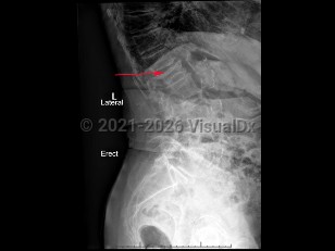 Osteoporotic vertebral compression fracture