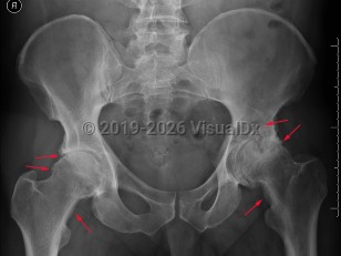 Imaging Studies image of Osteoarthritis - imageId=7919527. Click to open in gallery.  caption: '<span>Severe degenerative disease of  the left hip with joint space narrowing, subchondral sclerosis,  subchondral cysts, and osteophytosis. Moderate degenerative disease of  the right hip. There is also buttressing bilaterally. Findings are  compatible with osteoarthritis.</span>'
