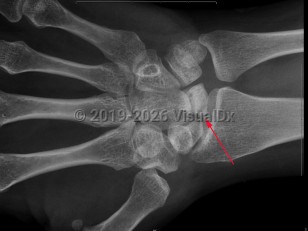 Imaging Studies image of Avascular necrosis - imageId=7924537. Click to open in gallery.  caption: '<span>Sclerosis and mild fragmentation of the lunate, compatible with Kienb&ouml;ck disease (avascular necrosis of the lunate).</span>'