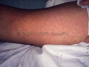 Clinical image of Zika virus infection - imageId=7934020. Click to open in gallery.  caption: 'Diffuse erythematous patches and plaques on the thigh.'