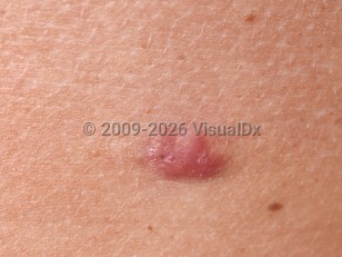 Eccrine poroma