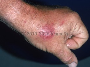 Coccidioidomycosis