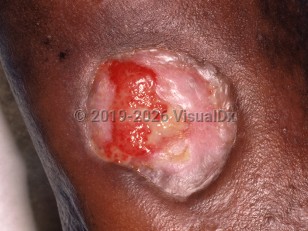 Pyoderma gangrenosum