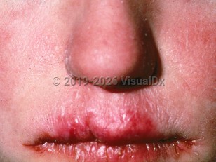 Clinical image of Chronic mucocutaneous candidiasis - imageId=800510. Click to open in gallery.  caption: 'Fissuring, erosion, and erythema of the lips.'