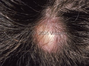 Pilar cyst