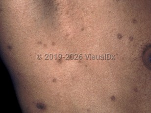 Postinflammatory hyperpigmentation