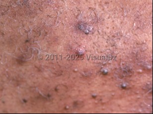 Steroid acne