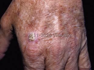 Actinic keratosis