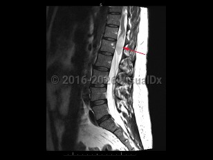 Cauda equina syndrome