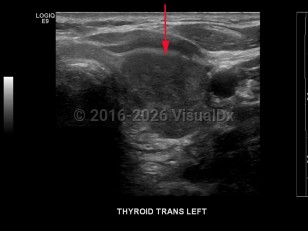 Thyroid cancer