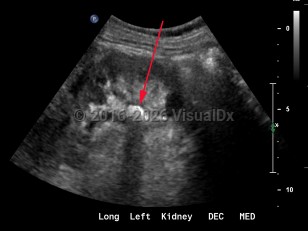Renal calculus