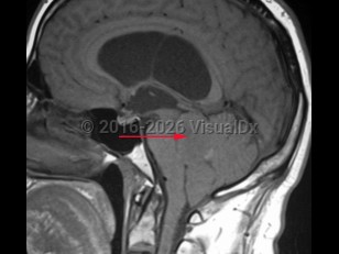 Ependymoma