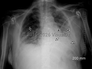 Acute interstitial pneumonia