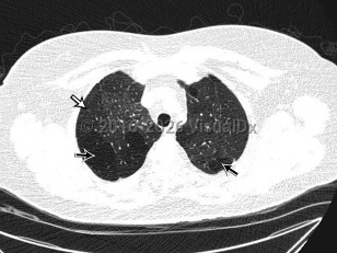 Bronchiolitis obliterans