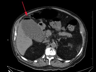 Emphysematous cholecystitis