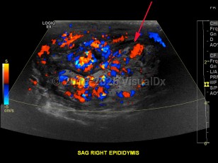 Imaging Studies image of Epididymo-orchitis - imageId=8358339. Click to open in gallery.  caption: '<span>Color Doppler ultrasound image demonstrating increased flow within the epididymis, consistent with epididymitis.</span>'