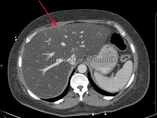 Metabolic dysfunction-associated steatotic liver disease