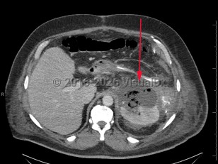 Imaging Studies image of Perinephric abscess - imageId=8360654. Click to open in gallery.  caption: '<span>Axial image from enhanced CT scan of the abdomen and pelvis with a complex left perirenal fluid collection with air, consistent with a perinephric abscess.</span>'