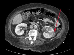 Imaging Studies image of Pyelonephritis - imageId=8360960. Click to open in gallery.  caption: '<span>Axial image from contrast enhanced CT scan demonstrating a peripheral, wedge-shaped, low attenuation region in the left kidney, consistent with pyelonephritis with possible abscess.</span>'