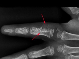 Imaging Studies image of Periosteal chondroma - imageId=8364755. Click to open in gallery.  caption: '<span>Radiograph of the ring finger demonstrates a lytic lesion involving the ulnar aspect of the proximal phalanx with saucerization of the cortex, a deep sclerotic margin, and chondroid calcifications extending into the soft tissues. These imaging findings at this location are most suggestive of a juxticortical chondroma.</span>'