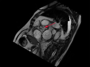 Imaging Studies image of Aortic stenosis - imageId=8368063. Click to open in gallery.  caption: '<span>Cardiac MRI without contrast demonstrates aortic stenosis.</span>'