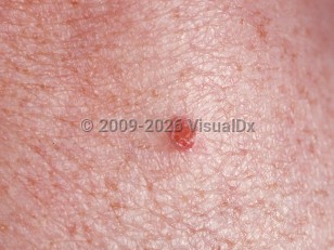 Clinical image of Clear cell acanthoma - imageId=84671. Click to open in gallery.  caption: 'A close-up of a bright red, flat-topped, scaly papule.'