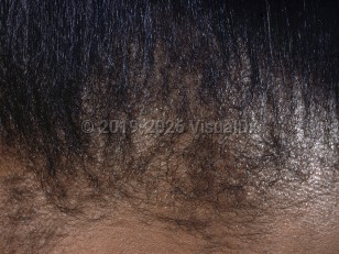 Traction alopecia