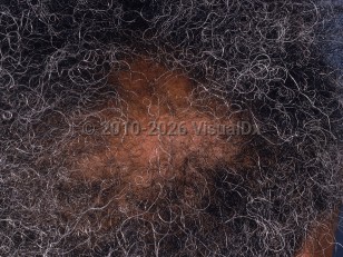 Central centrifugal cicatricial alopecia