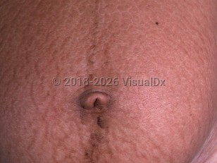 Striae