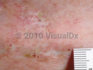 Livedoid vasculopathy