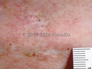 Livedoid vasculopathy