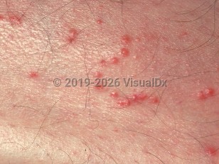 Fire ant sting