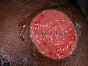 Tertiary syphilis