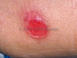Stage 2 pressure injury
