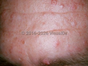 Clinical image of Muir-Torre syndrome - imageId=869424. Click to open in gallery.  caption: 'Numerous pink and yellow papules (sebaceous hyperplasia), some umbilicated, on the forehead.'