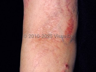 Steroid atrophy