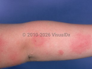 Solar urticaria
