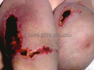 Heparin necrosis