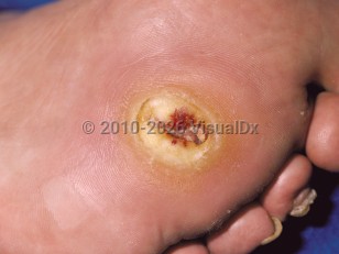 Clinical image of Neurogenic ulcer - imageId=88325. Click to open in gallery.  caption: 'An ulcerated hyperkeratotic plaque on the distal sole.'