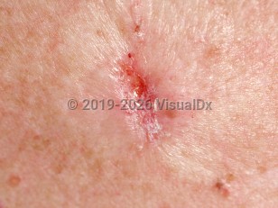 Infiltrating basal cell carcinoma