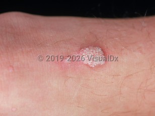 Common wart