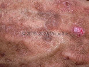 Variegate porphyria